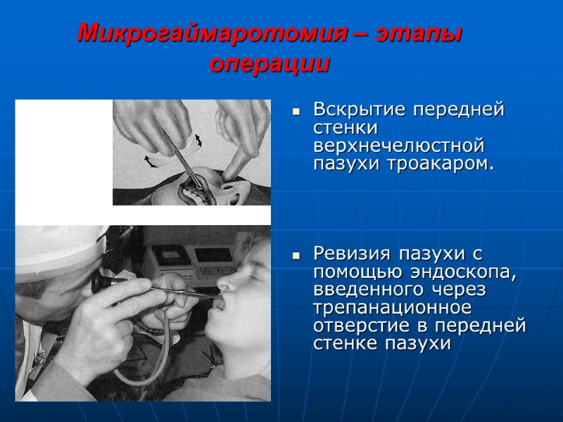 Микрогаймаротомия – этапы операции Вскрытие передней стенки верхнечелюстной пазухи троакаром.    Ревизия